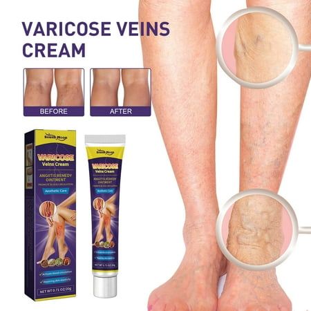 PARCHES PARA VARICES